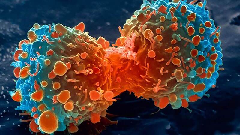 xét nghiệm tế bào ung thư cổ tử cung