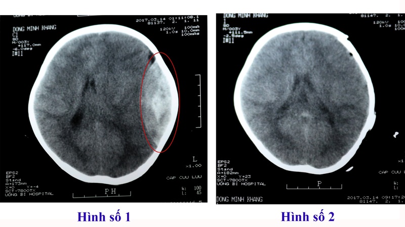 Chụp CT não giúp quan sát chi tiết cấu trúc não bộ