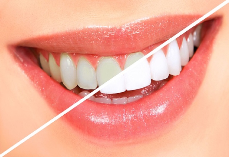 Tẩy trắng răng khá an toàn, hiệu quả nhanh