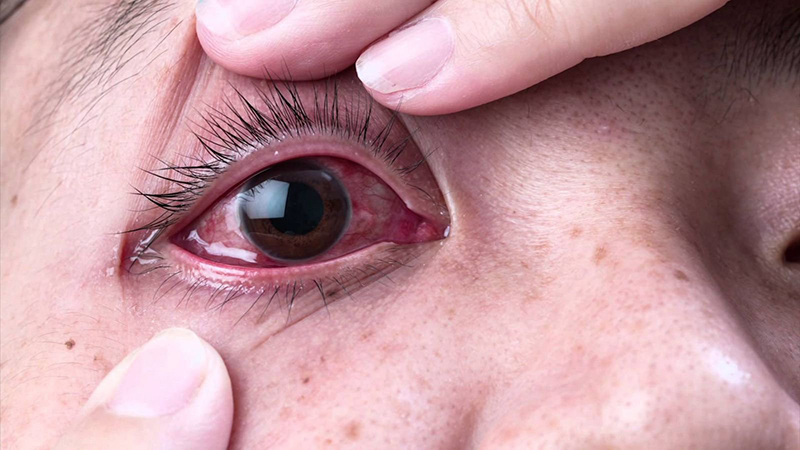 Đỏ mắt - triệu chứng thường xuất hiện ở bệnh sốt siêu vi