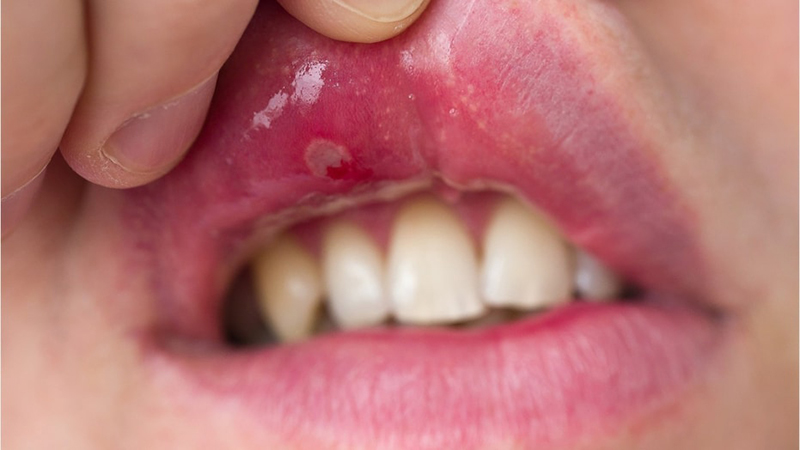 Bệnh nhân bị Lupus xảy ra các vấn đề liên quan đến khoang miệng