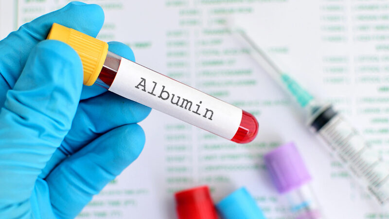 Albumin là protein đặc biệt được sản xuất ở gan