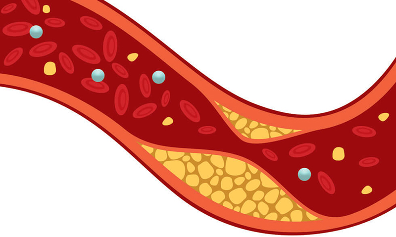 Chỉ số cholesterol giúp chúng ta xác định lượng mỡ máu và nguy cơ mắc xơ vữa động mạch