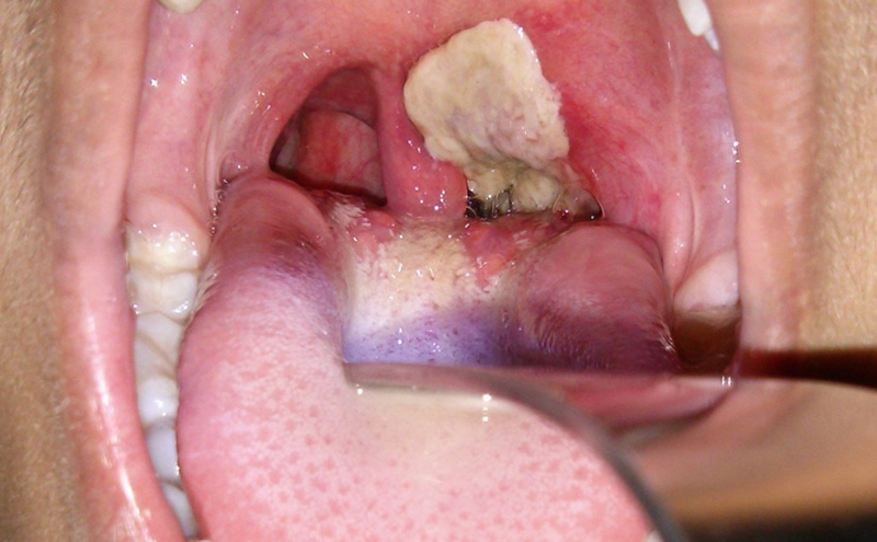 Biểu hiện khi mắc bệnh bạch hầu là những màng giả màu trắng hoặc xám bám vào vòm họng