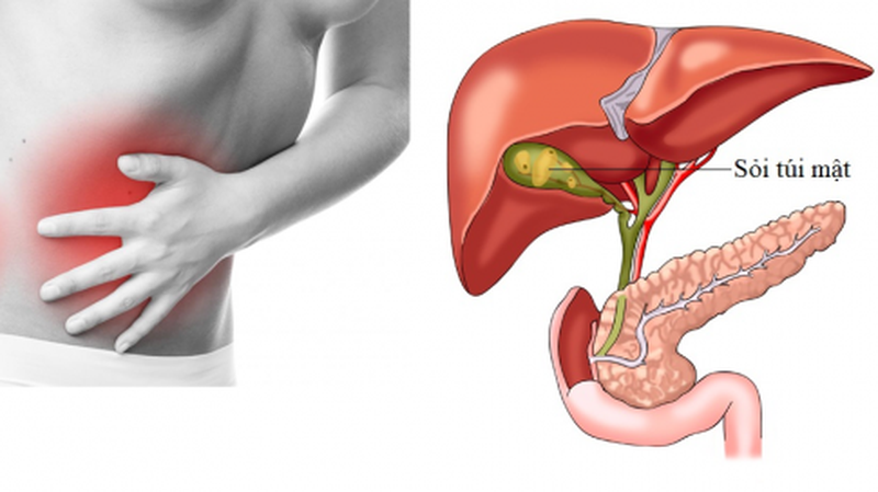 Sỏi túi mật gây nên các cơn đau ở bụng trái hoặc thượng vị
