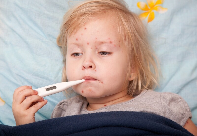 Người bệnh thủy đậu thường bị sốt và cần cách ly để tránh lây lan
