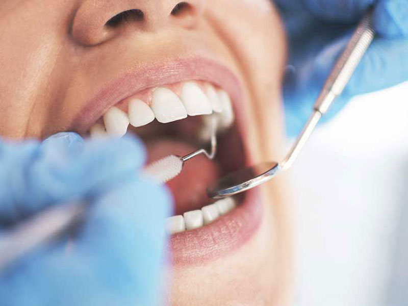Tiến hành cạo vôi răng trước khi phẫu thuật