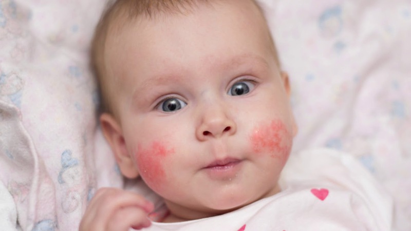 viêm da cơ địa ở trẻ thường gặp nhất ở trẻ sơ sinh do làn da của bé nhạy cảm