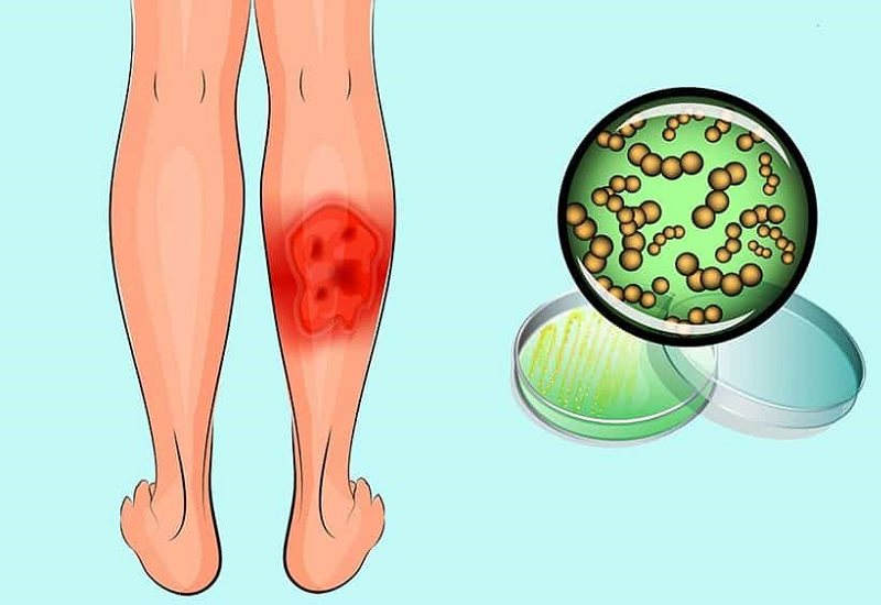 Bệnh viêm quầng (Erysipelas) là một thể bệnh viêm da mủ do liên cầu khuẩn gây ra có thể khiến người bệnh tử vong