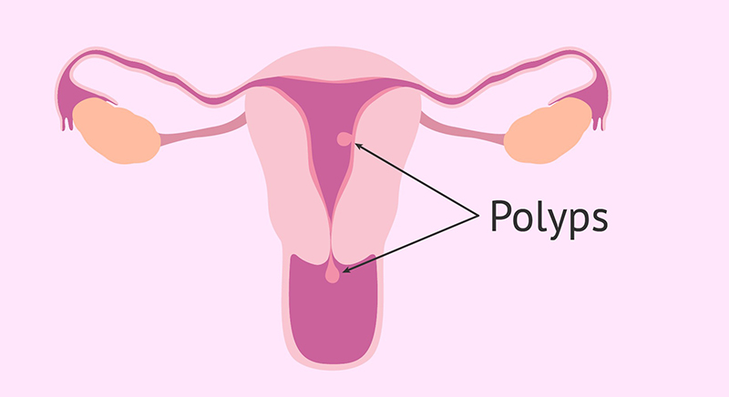 Thế nào là polyp tử cung, không phải ai cũng biết 