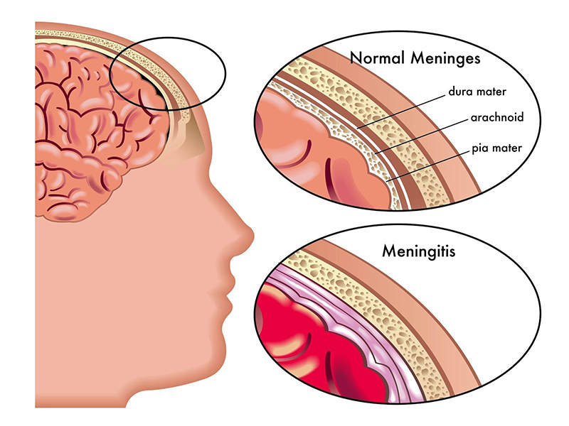 Các lớp màng não bị viêm nhiễm khiến cho vai trò bảo vệ não và tủy sống chịu ảnh hưởng 