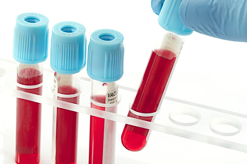 Các chỉ số xét nghiệm sinh hóa máu giúp bác sĩ đánh giá hiệu quả điều trị