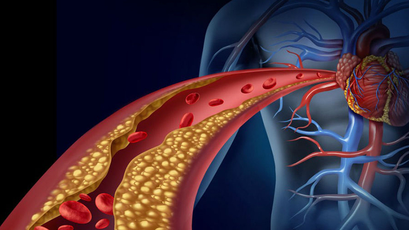 Cholesterol tích tụ trong mạch máu làm tăng nguy cơ gặp cơn đau tim cấp