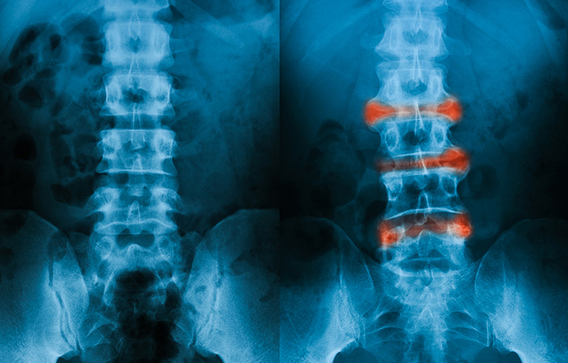 Phim chụp giữa cột sống bình thường (bên trái) và viêm cột sống dính khớp (bên phải)