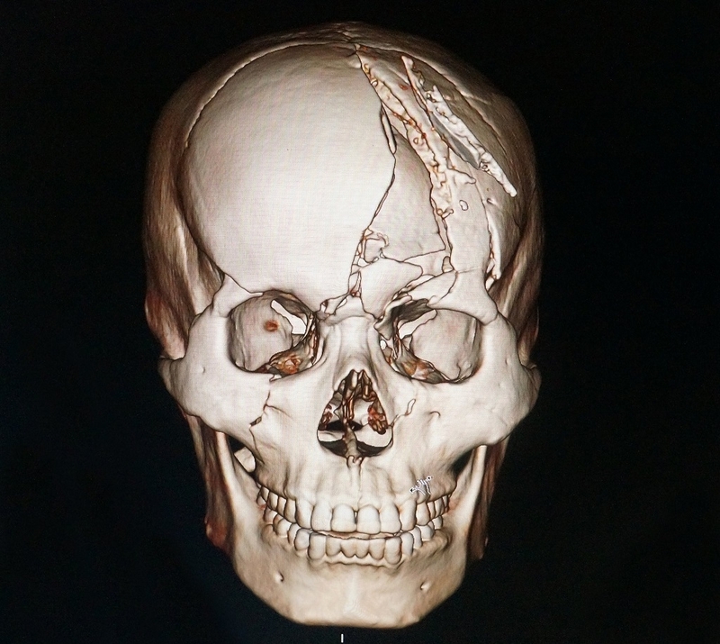 Vỡ xương vòm sọ thường ít gây triệu chứng thực thể