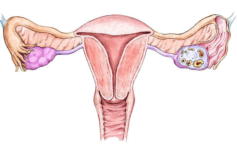 Lạc nội mạc tử cung gây đau bụng dưới ở nữ giới