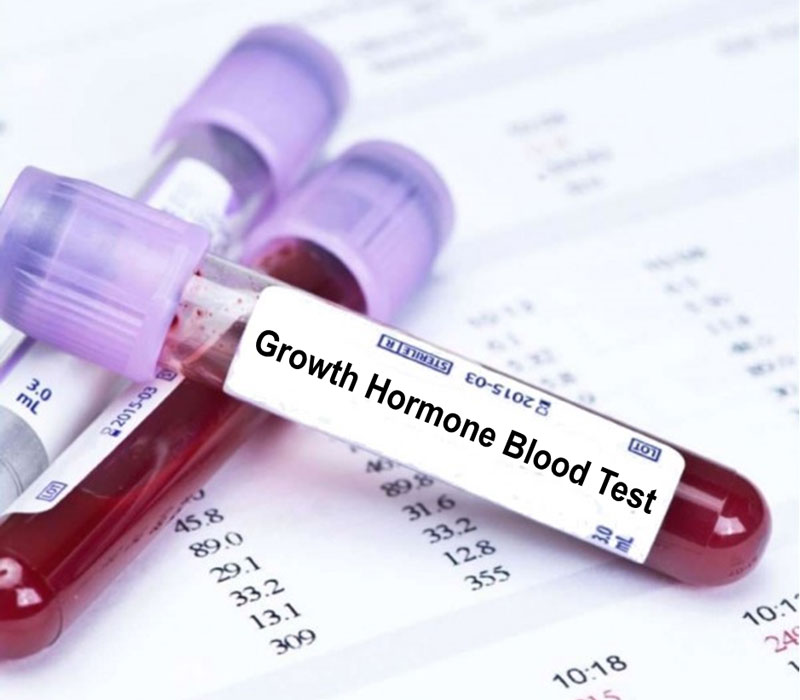 Xét nghiệm hormone tăng trưởng là một trong những xét nghiệm phổ biến hiện nay