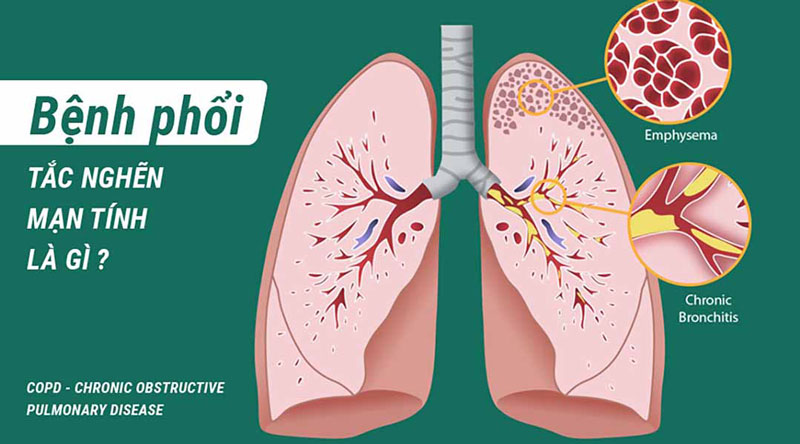 bệnh phổi tắc nghẽn mạn tính hay còn gọi là COPD