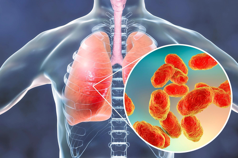 Áp xe phổi là tình trạng nhiễm trùng phổi tích dịch mủ