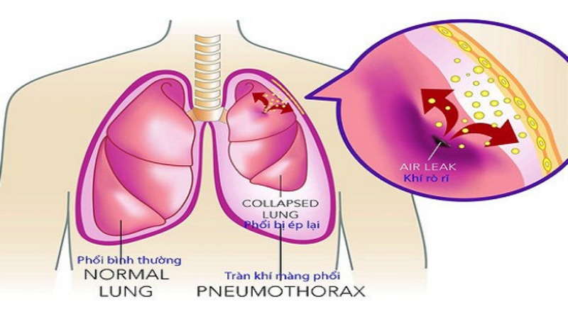 Vị trí rách màng phổi có thể tạo thành van một chiều thông khí