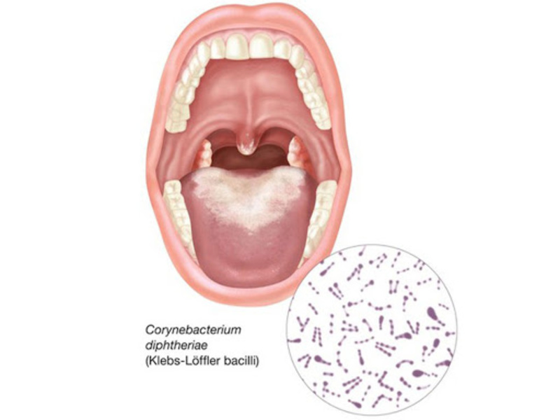 Vi khuẩn bạch hầu gây hình thành lớp giả mạc hầu họng
