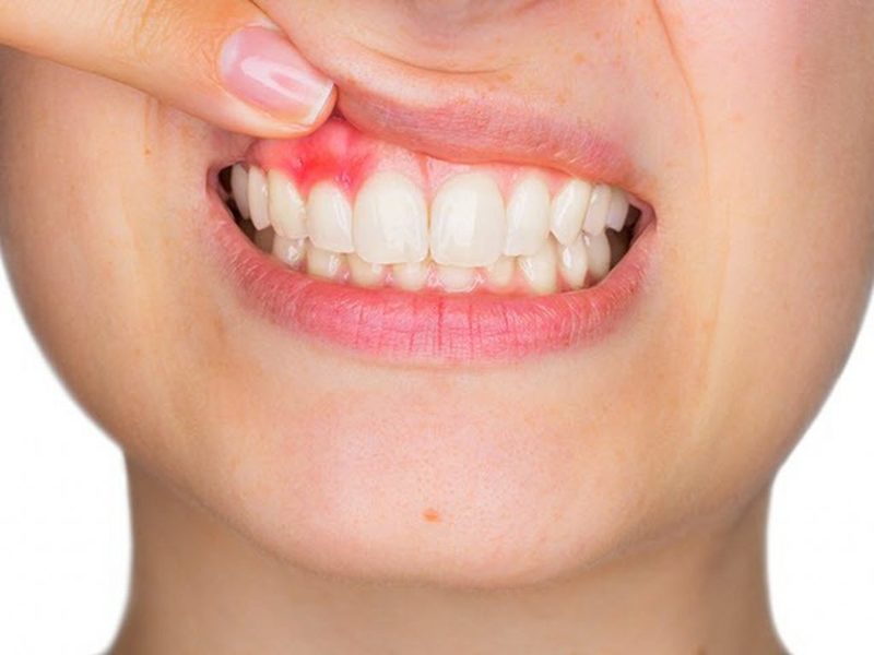 Nướu khu vực chảy máu chân răng thường bị viêm