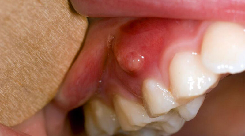 Viêm nướu cũng có thể gây chảy máu chân răng