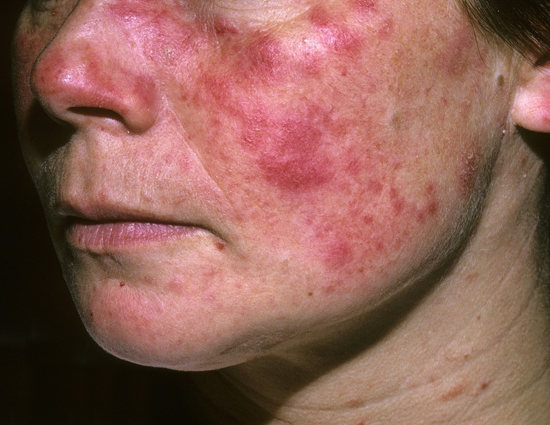 lupus ban đỏ là bệnh gì mà gây triệu chứng mẩn đỏ trên da mặt