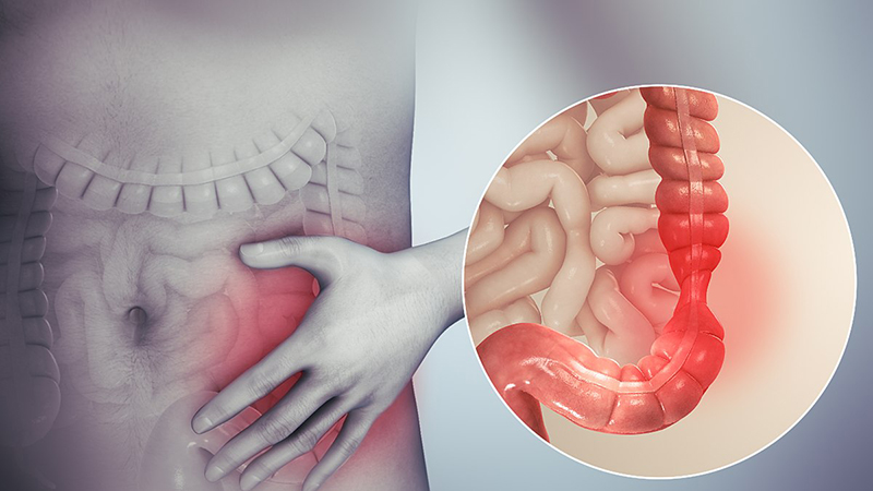 Vết loét ruột non do bệnh Celiac gây ra các phản ứng đối với hệ tiêu hoá