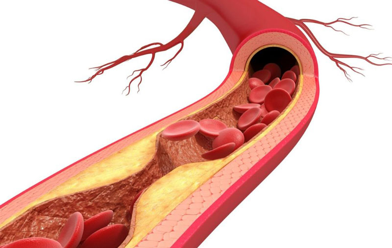 Xơ vữa động mạch làm tăng nguy cơ mắc bệnh