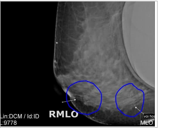 Hình ảnh chụp Mamography của bệnh nhân phát hiện bất thường