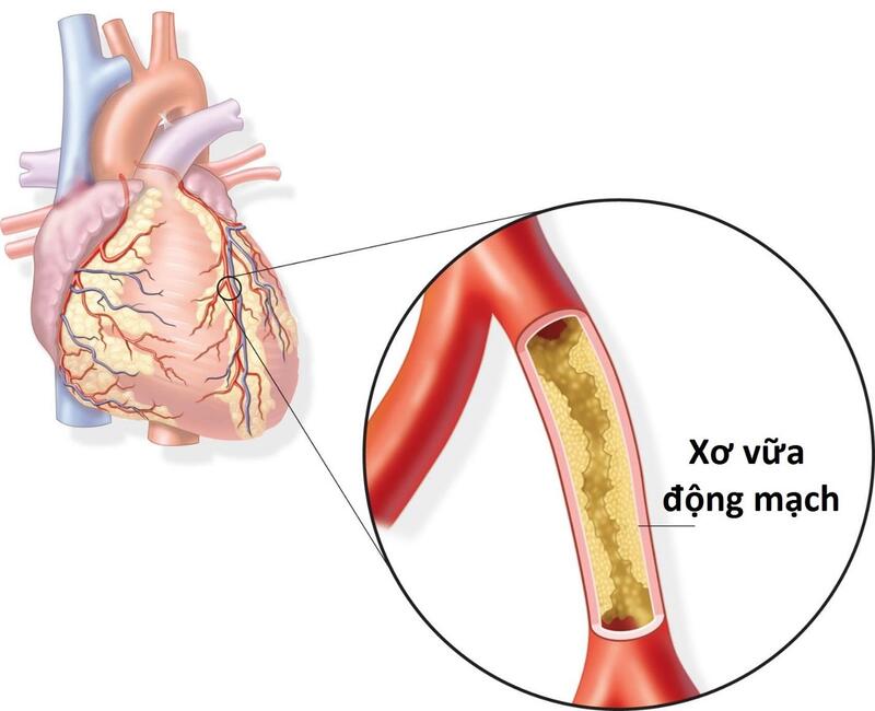 Mỡ máu cao gây xơ vữa động mạch chiếm 70% trường hợp nhồi máu cơ tim