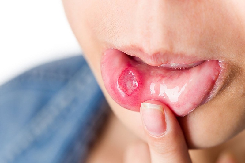 Khi có vết thương hở ở miệng, nguy cơ lây nhiễm sẽ càng cao