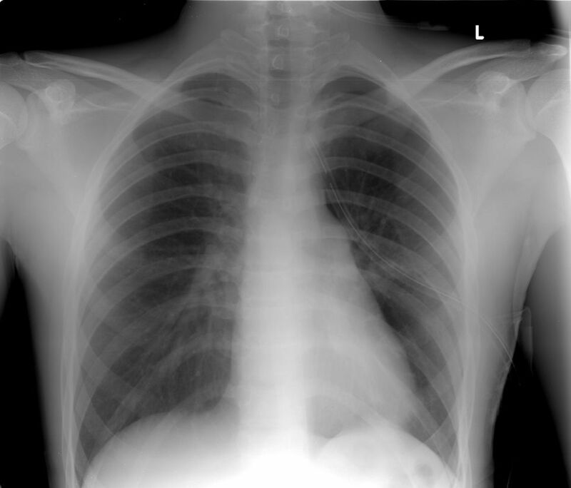 Tràn khí màng phổi ở người có bệnh lý phổi thường nguy hiểm hơn