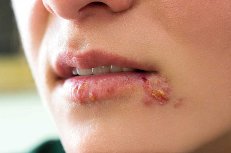 Bệnh Herpes miệng gây ra mụn rộp đau đớn trên da