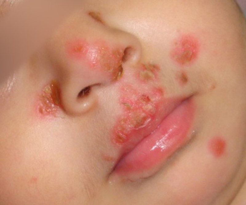 Trẻ nhỏ là đối tượng dễ bị Herpes miệng