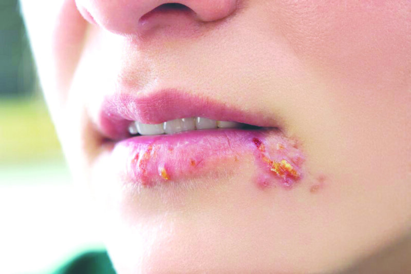 Herpes môi là bệnh do virus gây ra