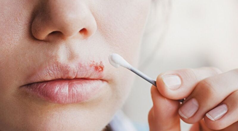 Virus gây Herpes môi có thể lây nhiễm qua tiếp xúc gần