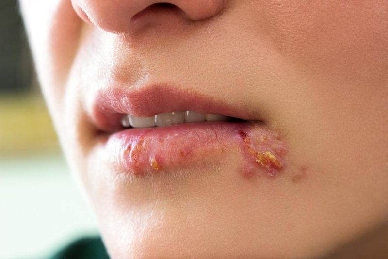 Tổn thương da ở miệng do virus Herpes gây ra