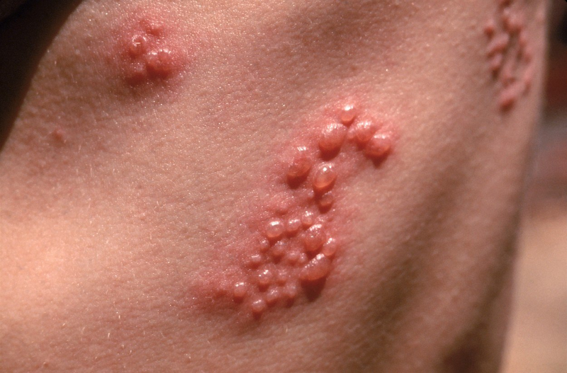 Chẩn đoán Herpes thường dựa trên biểu hiện lâm sàng