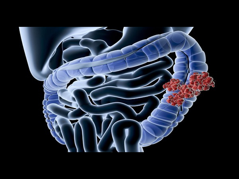 nguyên nhân gây ra bệnh crohn đặc trưng bởi tình trạng viêm ruột từng phần