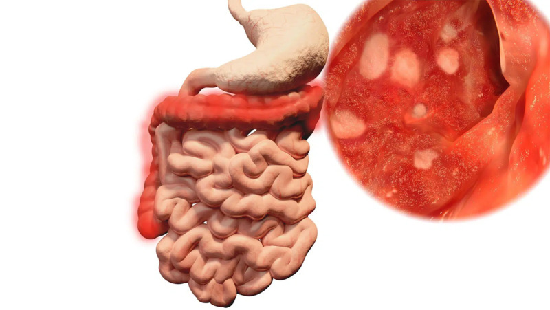 Bệnh Crohn có thể gây loét và thủng ruột