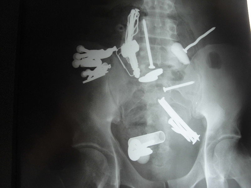 Hình ảnh chụp X - quang hiển thị rõ vị trí của dị vật trong trực tràng