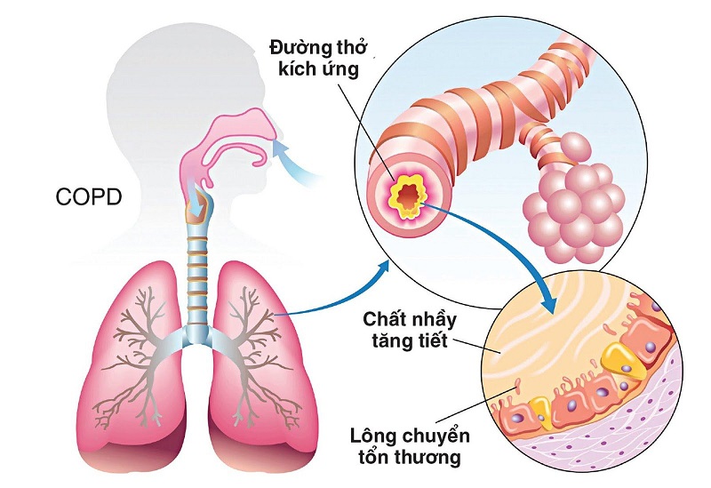 Bệnh tắc nghẽn phổi mãn tính làm thu hẹp đường thở.
