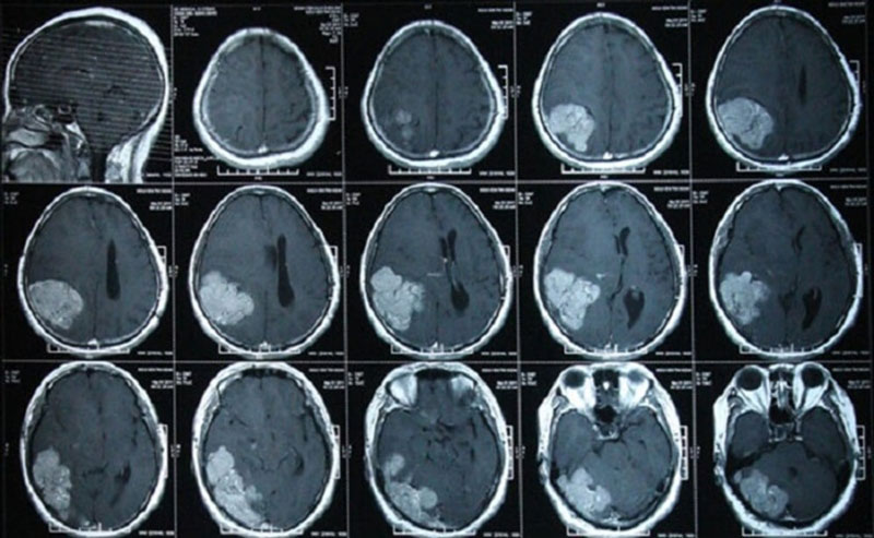 Chụp CT não cho hình ảnh rõ nét và chân thực giúp bác sĩ đưa ra những chẩn đoán chính xác nhất 