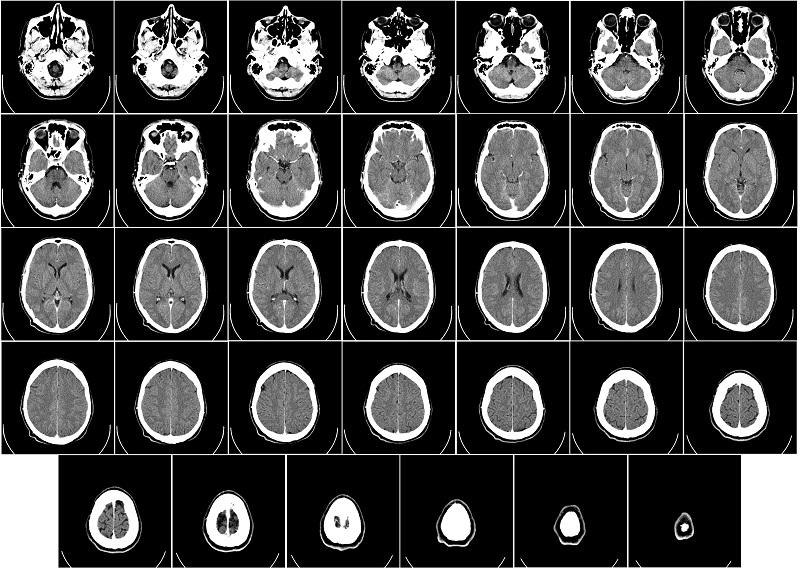 Chụp CT não có ảnh hưởng gì không là băn khoăn của nhiều người