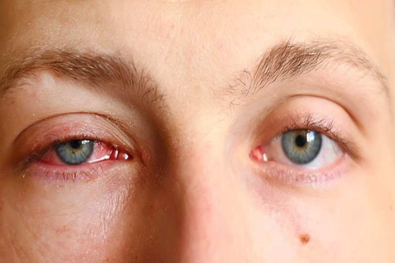 Nhìn vào mắt người bị đau mắt đỏ bị lây