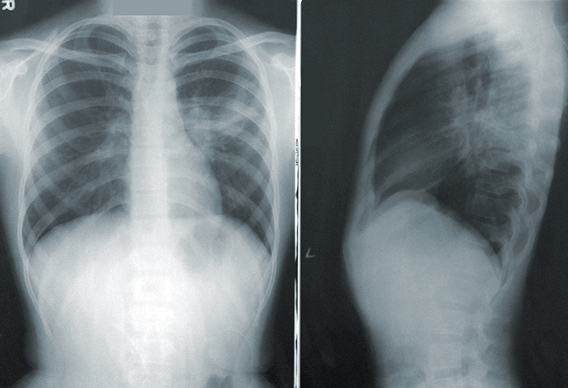 Hình ảnh chụp X- quang phổi thẳng nghiêng