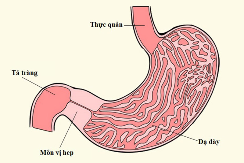 Hình mô tả khi cơ môn vị dày lên làm hẹp van giữa dạ dày và ruột non
