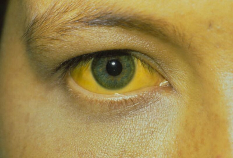 Vàng da và mắt